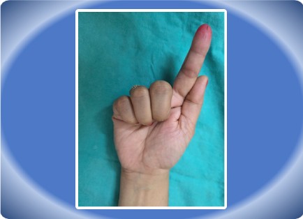 TENDON INJURY